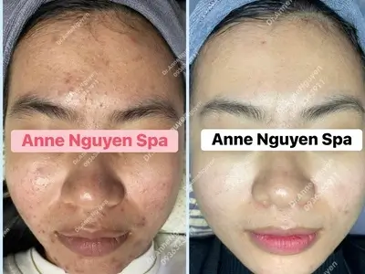Điều trị mụn bằng công nghệ ánh sáng Omega Light